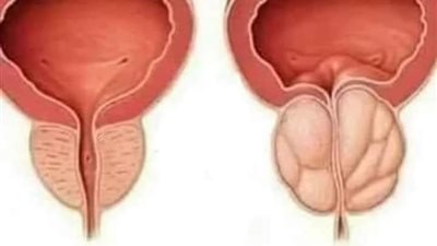 تمارين لعلاج ضعف المثانة 