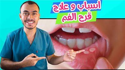 وصفة فعاله لالتهابات الفم والكحه 