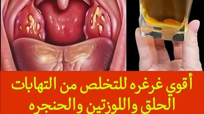 مشروب يعالج الكحة والتهاب الحلق