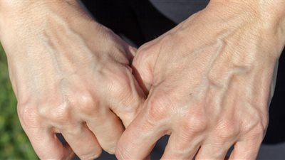 علاج ظهور العروق البارزة 