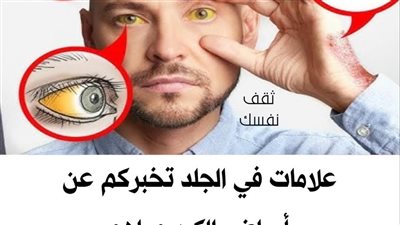علامات في الجلد تخبركم عن أمراض الكبد وماهو أفضل طعام للكبد