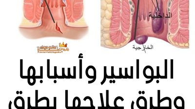 البواسير اسبابها وطرق علاجها 