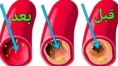 علاج انسداد الشرايين بطريقة طبيعية 