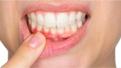 كيف تصنع مسحوق لتبييض الاسنان 