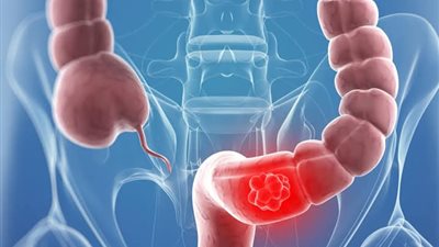 سړطان القولون اسبابه وطرق علاجه 