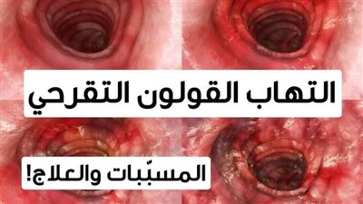 وصفة عظيمة تعالج القولون التقرحي وقرحة المعدة و ټقتل جرثومة المعدة مهما كانت قوية