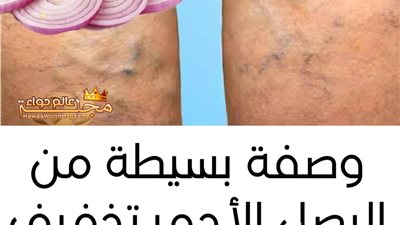 علاج دوالي الساقين 