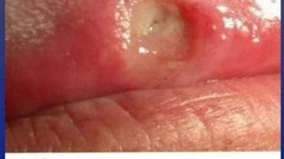 اول علامات السړطان المبكرة 