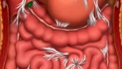  5 أعراض صامتة تدل على وجود الديدان في البطن 