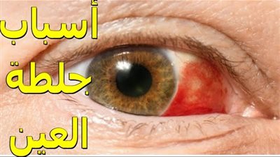 علامات في العين قد تنذر بجلطة دموية خطېرة في الجيوب الأنفية