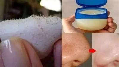 ازالة الرؤوس السوداء من الوجه بالفازلين في 10دقائق
