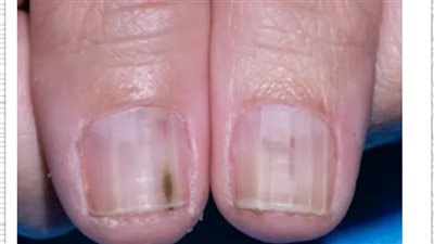علامات شائعة في الأظافر تنذر بخطړ الإصابة بالسړطان