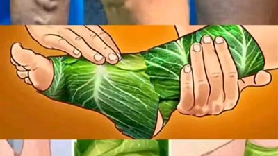 مدهـش التخلص من الدوالي فقط ضع هذه الاوراق 