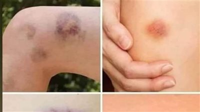 احذر من هذه التجلطات إليك علامات مرضية صامتة تدل على وجود جلطات بالجسم دون أن يشعر الإنسان