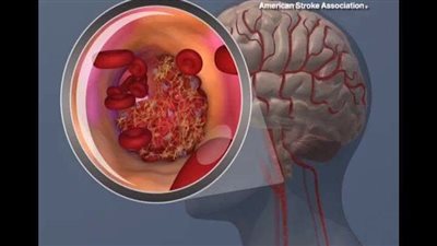 دراسة تؤكد أن المـشي لمدة 35 دقيقة يمكن أن يقـلل من خطړ السكـتة الدماغية