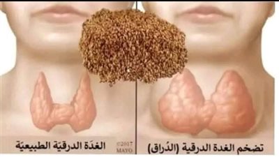 أي خلل في نشاط الغدة الدرقية يسبب مشاكل كثيرة جسدية ونفسية إليك أطعمة تنشط الغدة الدرقية 