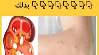 6 أعراض خلى بالك منها تشير إلى وجود مشاكل بالكـلى 