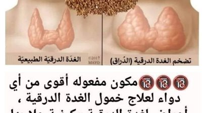 مكون مفعوله أقوى من أي دواء لعـلاج خمول الغدة الدرقية ، أعراض لغدة الدرقية وكيفية عـلاجها طبيعيا 