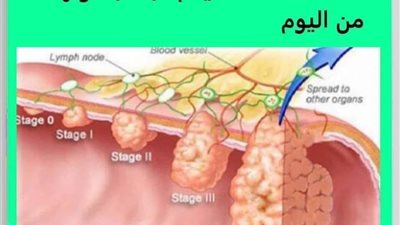 السـرطــان ېموت فوراً إذا تناولت هذه الأطعمة عليكم البدء بتناولها 
