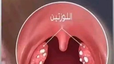 أقوى غرغره للتخلص من التهابات الحلق واللوزتين والحنجرة ورائحة الفم الكريهة ومذيب للبلغم و مبيض للأسنان