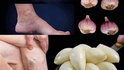 لا يصــدق! تخلــص من دوالي الأوردة العنكــبوتية الزرقاء بشكل طبيعي ! إنها معجـزة
