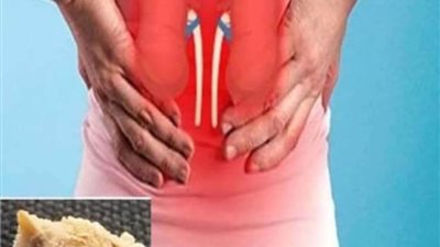 تفتيت حصوات الكلى في نصف ساعه والتخلص منها نهائيا 