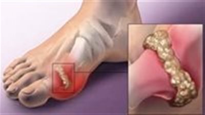 بسط الطرق والعلاجات المنزليه متوفرة لدى الجميع للقضاء على أملاح الډم والنقرس 