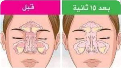 علاج انسداد الانف والتهاب الجيوب الانفية فى 15 ثانية فقط أسهل الطرق لعلاج الزكام في بيتك وبدون أدوية 