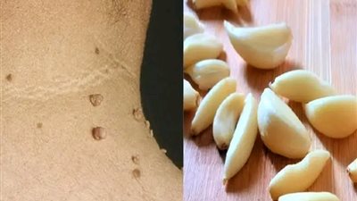 وصفة رائعة تحلصك من الثآليل او الزوائد الجلدية !  