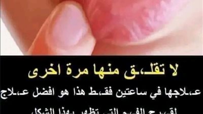 لا تقلــق منها مرة اخرى علاجها في ساعتين فقــط هذا هو افضل عـلاج لقرح الفـم
