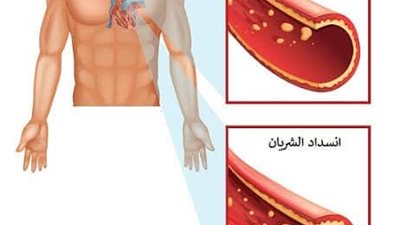 مجربة بنجاح لتنظيف الشرايين من الدهون المتراكمة