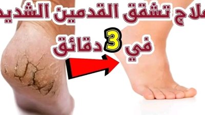 علاج تشققات الكعبين بالليمون