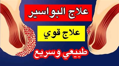 علاج البواسير طبيعيا 