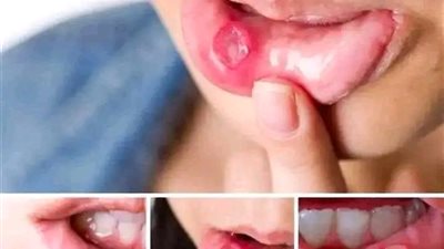 علاج تقرحات الفم