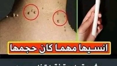 التخلص من الثآليل والزوائد الجلدية 