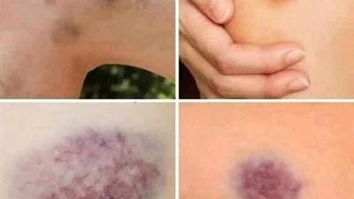 8 أعراض مبكرة للجلطة القلبية 