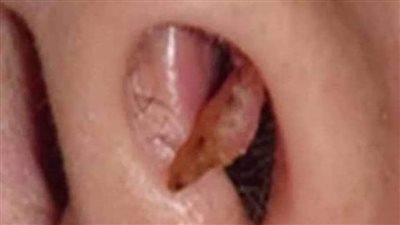 كيف أتصرف عند دخول جسم غريب في الأذن؟  