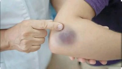 العلامات الزرقاء على الجسم ليست مجرد كدمات عادية، هناك مشاكل صحية خطېرة قد تسببها خاصة إذا كانت متكررة او بدون سبب..