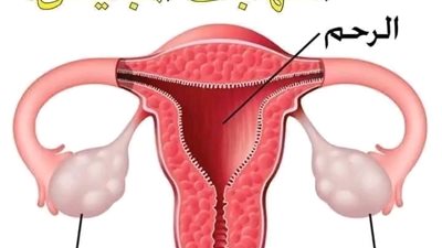 علاج التهابات المبايض