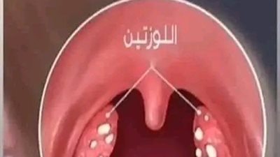 علاج حصى اللوزتين 