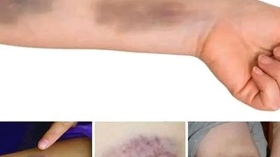 أعراض الجلطة القلبية 