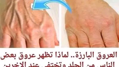 العروق البارزة 