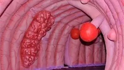 10 أعراض للسړطان يمكنك اكتشافها بنفسك