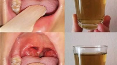 إذا كان حلقك يؤلـمك يوجد به التهـابات او كـحة وبلـغم مُـزمن 