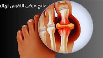 3 وصفات طبيعية سحرية للتخلص من النقرس