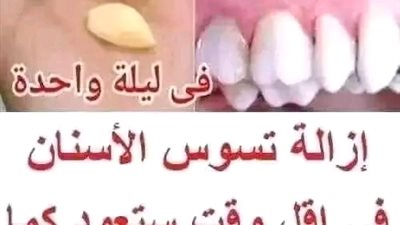 وصفات لعلاج تسوس الاسنان
