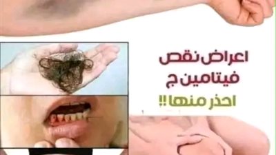 نقص فيتامين سي 