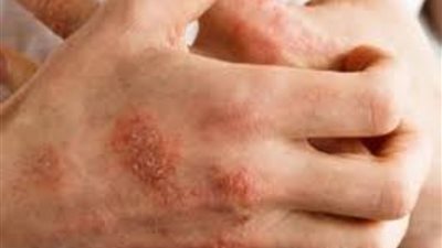تعرفوا الى طرق علاج الأكزيما بزبدة الشيا وطرق أخرى 