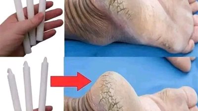 علاج تشققات الكعبين
