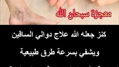 كنز جعله الله علاج دوالي الساقين ويشفي بسرعة 